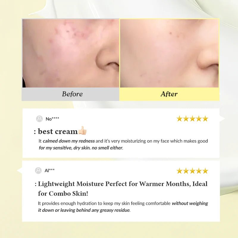 [ Acne Scar & Dark Spot Treatment Kit] – Korean Niacinamide Serum & Soothing Cream for Hyperpigmentation
